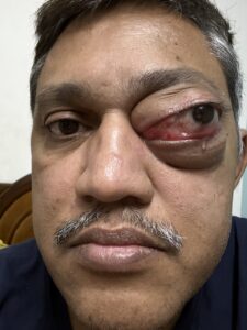 MY JOURNEY WITH A RARE TUMOUR BEHIND EYE 13 IMG 1532