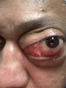 MY JOURNEY WITH A RARE TUMOUR BEHIND EYE 12 IMG 1533