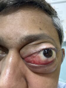 MY JOURNEY WITH A RARE TUMOUR BEHIND EYE 11 IMG 1566