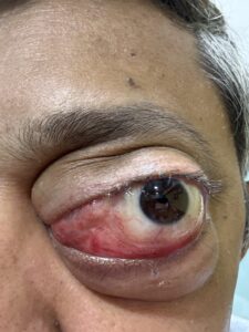 MY JOURNEY WITH A RARE TUMOUR BEHIND EYE 10 IMG 1567