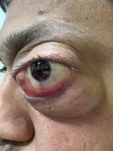 MY JOURNEY WITH A RARE TUMOUR BEHIND EYE 9 IMG 1568