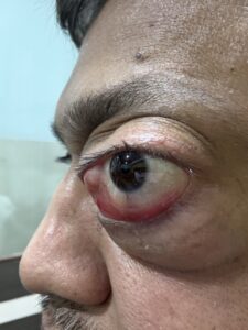 MY JOURNEY WITH A RARE TUMOUR BEHIND EYE 8 IMG 1569