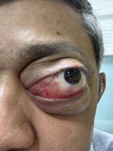 MY JOURNEY WITH A RARE TUMOUR BEHIND EYE 7 IMG 1570
