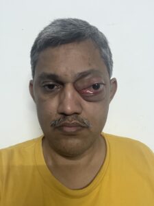 MY JOURNEY WITH A RARE TUMOUR BEHIND EYE 6 IMG 1619