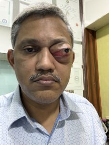 MY JOURNEY WITH A RARE TUMOUR BEHIND EYE 5 IMG 1626 2