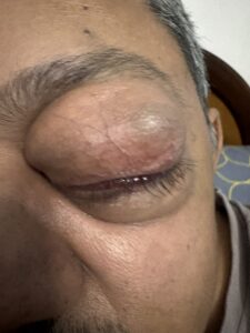 MY JOURNEY WITH A RARE TUMOUR BEHIND EYE 4 IMG 1647 2