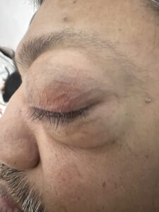 MY JOURNEY WITH A RARE TUMOUR BEHIND EYE 3 IMG 1648 2