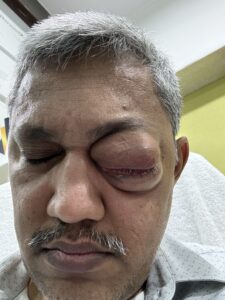 MY JOURNEY WITH A RARE TUMOUR BEHIND EYE 2 IMG 1740