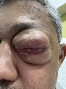 MY JOURNEY WITH A RARE TUMOUR BEHIND EYE 1 IMG 1742