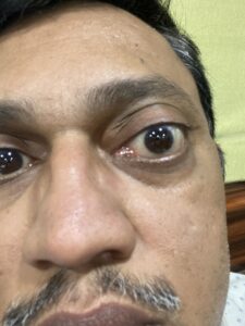 MY JOURNEY WITH A RARE TUMOUR BEHIND EYE 119 IMG 2435