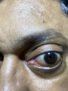 MY JOURNEY WITH A RARE TUMOUR BEHIND EYE 118 IMG 2656