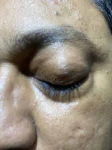 MY JOURNEY WITH A RARE TUMOUR BEHIND EYE 117 IMG 2657