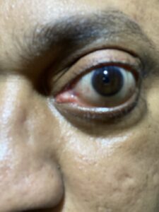MY JOURNEY WITH A RARE TUMOUR BEHIND EYE 116 IMG 2659