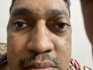 MY JOURNEY WITH A RARE TUMOUR BEHIND EYE 115 IMG 2665