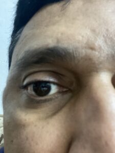 MY JOURNEY WITH A RARE TUMOUR BEHIND EYE 114 IMG 2667