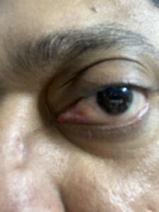 MY JOURNEY WITH A RARE TUMOUR BEHIND EYE 113 IMG 2668