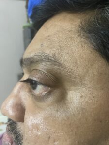 MY JOURNEY WITH A RARE TUMOUR BEHIND EYE 112 IMG 2765