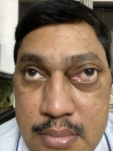 MY JOURNEY WITH A RARE TUMOUR BEHIND EYE 111 IMG 2769