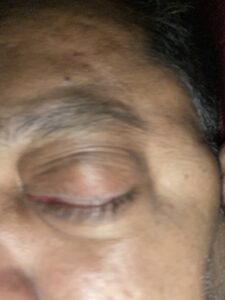 MY JOURNEY WITH A RARE TUMOUR BEHIND EYE 110 IMG 2797