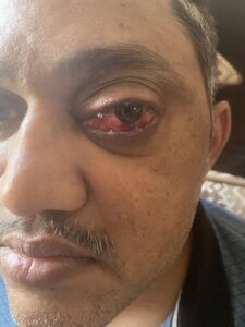 MY JOURNEY WITH A RARE TUMOUR BEHIND EYE 109 IMG 2862