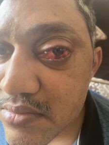 MY JOURNEY WITH A RARE TUMOUR BEHIND EYE 108 IMG 2863