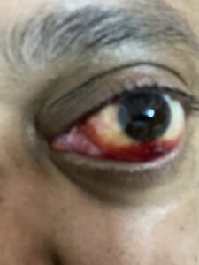MY JOURNEY WITH A RARE TUMOUR BEHIND EYE 107 IMG 2973