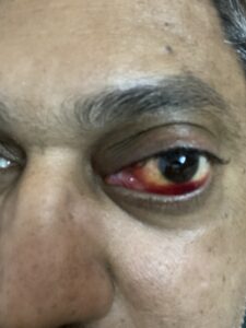 MY JOURNEY WITH A RARE TUMOUR BEHIND EYE 106 IMG 2974