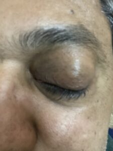 MY JOURNEY WITH A RARE TUMOUR BEHIND EYE 105 IMG 2975
