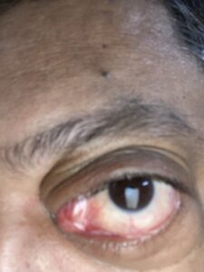 MY JOURNEY WITH A RARE TUMOUR BEHIND EYE 104 IMG 3916