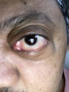 MY JOURNEY WITH A RARE TUMOUR BEHIND EYE 103 IMG 3917