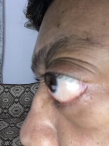 MY JOURNEY WITH A RARE TUMOUR BEHIND EYE 102 IMG 3918