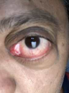 MY JOURNEY WITH A RARE TUMOUR BEHIND EYE 101 IMG 4094