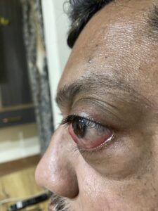 MY JOURNEY WITH A RARE TUMOUR BEHIND EYE 100 IMG 4097