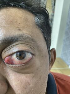 MY JOURNEY WITH A RARE TUMOUR BEHIND EYE 99 IMG 4099