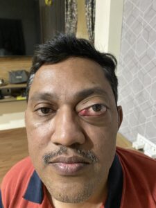 MY JOURNEY WITH A RARE TUMOUR BEHIND EYE 98 IMG 4100
