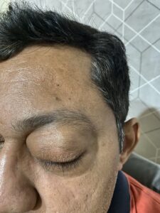 MY JOURNEY WITH A RARE TUMOUR BEHIND EYE 97 IMG 4101