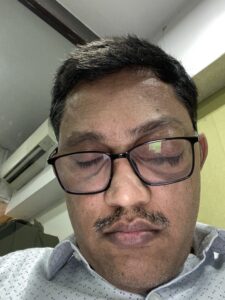 MY JOURNEY WITH A RARE TUMOUR BEHIND EYE 95 IMG 4244