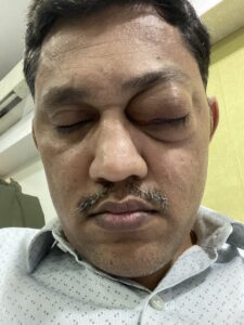 MY JOURNEY WITH A RARE TUMOUR BEHIND EYE 94 IMG 4245
