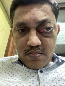 MY JOURNEY WITH A RARE TUMOUR BEHIND EYE 92 IMG 4253