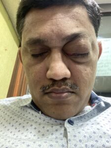MY JOURNEY WITH A RARE TUMOUR BEHIND EYE 91 IMG 4254