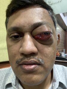MY JOURNEY WITH A RARE TUMOUR BEHIND EYE 90 IMG 4388