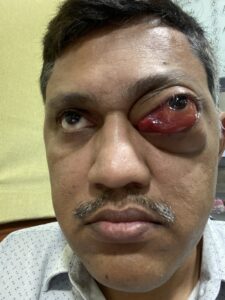 MY JOURNEY WITH A RARE TUMOUR BEHIND EYE 89 IMG 4389