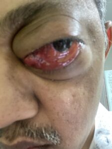 MY JOURNEY WITH A RARE TUMOUR BEHIND EYE 88 IMG 4395