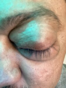 MY JOURNEY WITH A RARE TUMOUR BEHIND EYE 87 IMG 4788