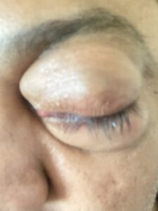 MY JOURNEY WITH A RARE TUMOUR BEHIND EYE 86 IMG 4789