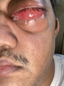 MY JOURNEY WITH A RARE TUMOUR BEHIND EYE 85 IMG 4849