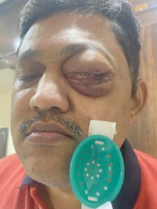 MY JOURNEY WITH A RARE TUMOUR BEHIND EYE 83 IMG 4867