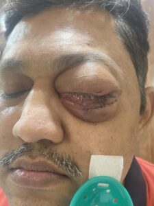 MY JOURNEY WITH A RARE TUMOUR BEHIND EYE 82 IMG 4868