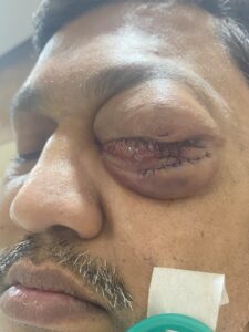 MY JOURNEY WITH A RARE TUMOUR BEHIND EYE 81 IMG 4869