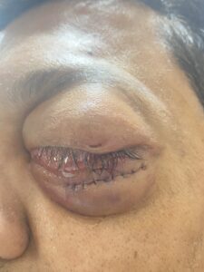 MY JOURNEY WITH A RARE TUMOUR BEHIND EYE 80 IMG 4870